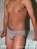 papilomatosis confluentes and reticulate