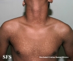 papilomatosis confluentes and reticulate