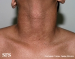 papilomatosis confluentes and reticulate