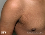 papilomatosis confluentes and reticulate