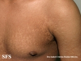 papilomatosis confluentes and reticulate