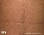 papilomatosis confluentes and reticulate