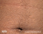 papilomatosis confluentes and reticulate