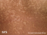 papilomatosis confluentes and reticulate