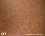 papilomatosis confluentes and reticulate