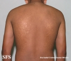 papilomatosis confluentes and reticulate