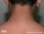 papilomatosis confluentes and reticulate