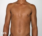papilomatosis confluentes and reticulate