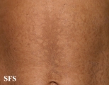 papilomatosis confluentes and reticulate