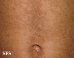 papilomatosis confluentes and reticulate