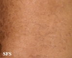 papilomatosis confluentes and reticulate