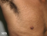 papilomatosis confluentes and reticulate