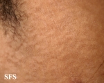 papilomatosis confluentes and reticulate