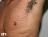 papilomatosis confluentes and reticulate