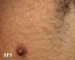 papilomatosis confluentes and reticulate