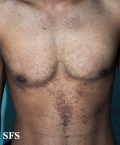 papilomatosis confluentes and reticulate