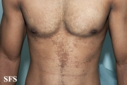 papilomatosis confluentes and reticulate