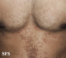 papilomatosis confluentes and reticulate