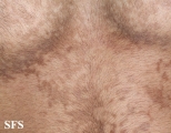 papilomatosis confluentes and reticulate