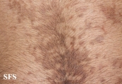 papilomatosis confluentes and reticulate