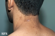 papilomatosis confluentes and reticulate