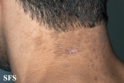 papilomatosis confluentes and reticulate