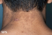 papilomatosis confluentes and reticulate