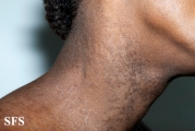 papilomatosis confluentes and reticulate