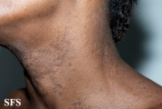 papilomatosis confluentes and reticulate
