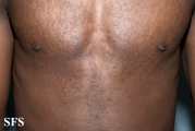 papilomatosis confluentes and reticulate