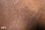 papilomatosis confluentes and reticulate