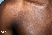 papilomatosis confluentes and reticulate