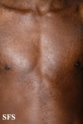 papilomatosis confluentes and reticulate