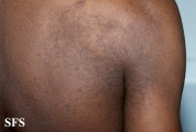 papilomatosis confluentes and reticulate