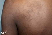 papilomatosis confluentes and reticulate