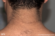 papilomatosis confluentes and reticulate