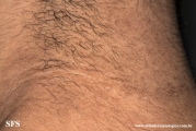 papilomatosis confluentes and reticulate
