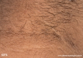 papilomatosis confluentes and reticulate