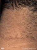 papilomatosis confluentes and reticulate