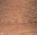 papilomatosis confluentes and reticulate