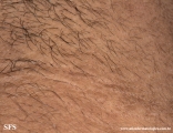 papilomatosis confluentes and reticulate