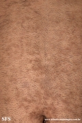 papilomatosis confluentes and reticulate