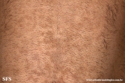 papilomatosis confluentes and reticulate