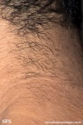 papilomatosis confluentes and reticulate