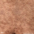 papilomatosis confluentes and reticulate