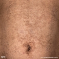 papilomatosis confluentes and reticulate