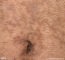 papilomatosis confluentes and reticulate