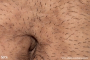 papilomatosis confluentes and reticulate