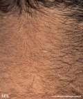 papilomatosis confluentes and reticulate