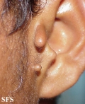accessory tragus